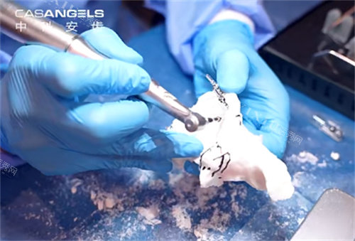 中科安齿种植牙操作过程