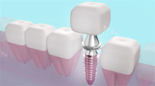 种植牙透视动画展示图