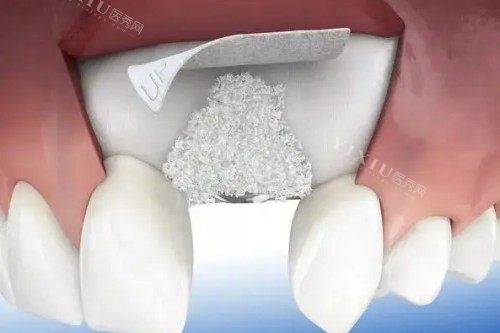 种植牙植骨卡通展示图