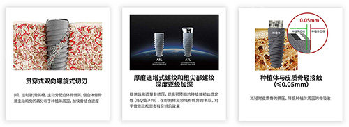 卡尔斯种植牙有什么不同