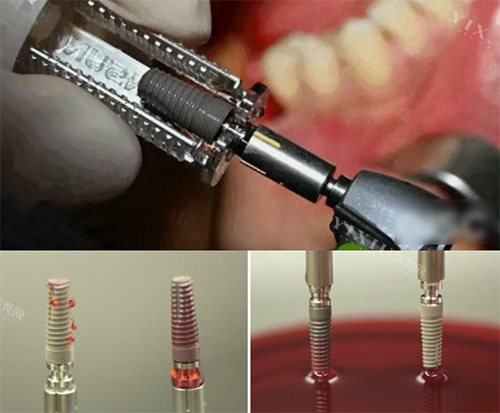 康盛种植牙照片