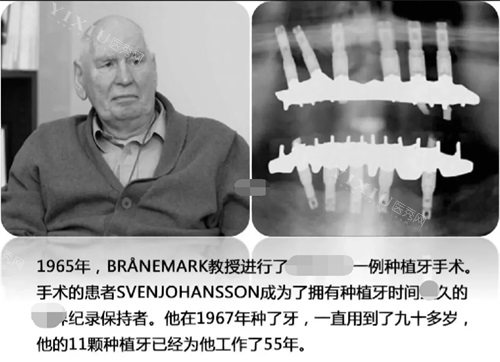 种植牙记录示意图