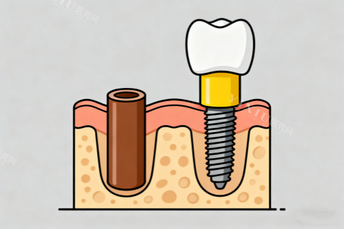 单颗种植牙卡通图展示