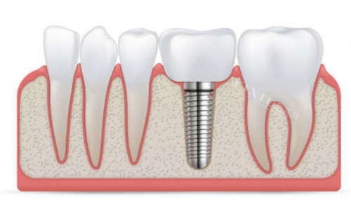 种植牙和临牙示意图