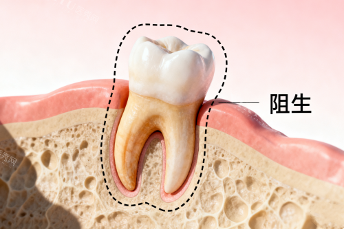 口腔智齿卡通展示图