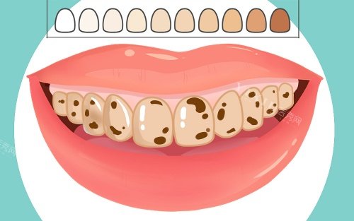 牙齿比色示意图