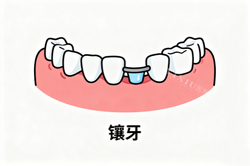 镶牙卡通图一览
