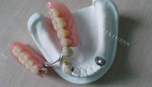 活动假牙半口展示