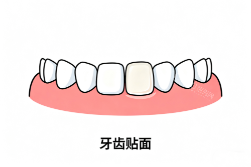 牙齿贴面卡通展示图