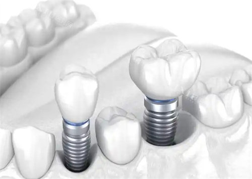 种植牙图片展示