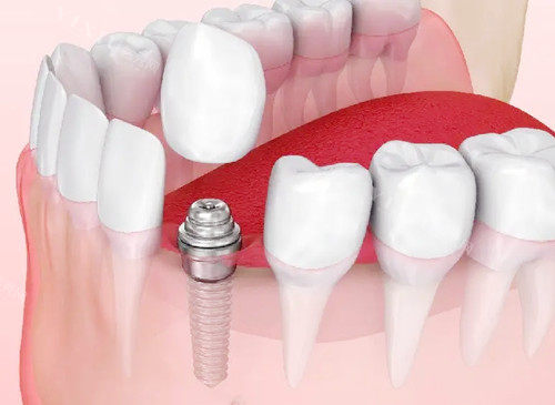 健康牙齿离不开定期检查