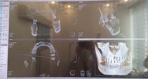 珠海仁爱口腔牙齿拍片