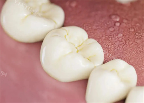 没有正确刷牙的牙齿