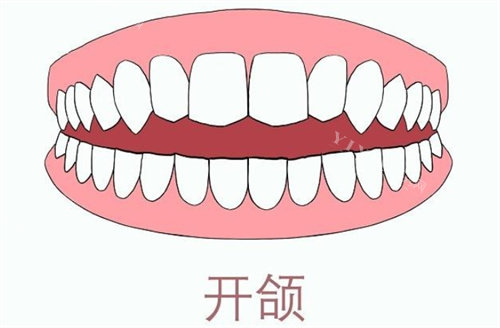 牙齿开颌