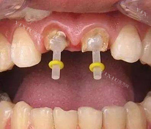 牙齿打桩示意图