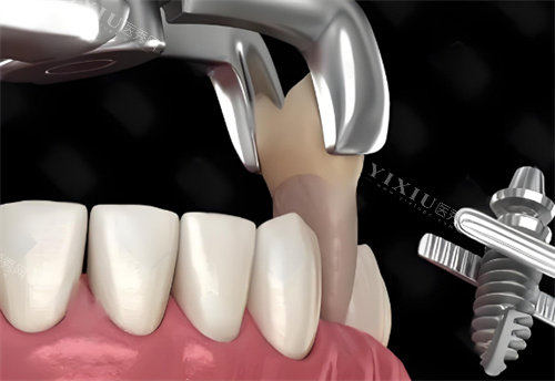 拔牙动画展示图片