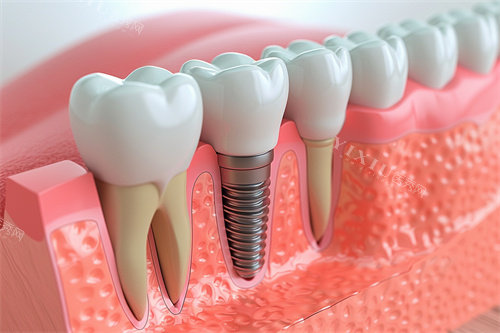 种植牙与正常牙齿模型对比漫画图