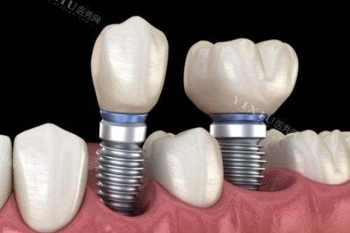 种植牙修复卡通一览