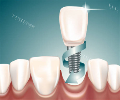 种植牙在口腔图