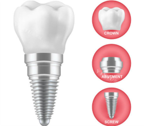 种植牙的三部分