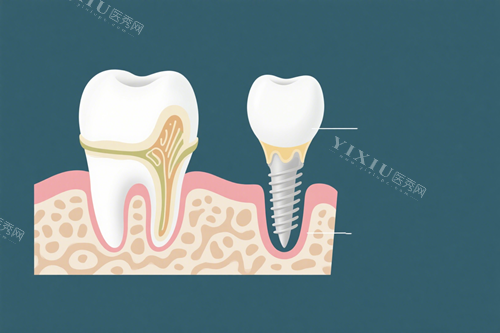 种植牙示意图 (1)