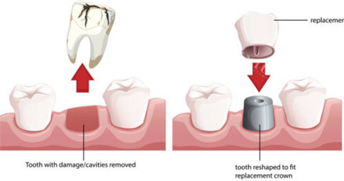 种植牙拔牙和戴冠图