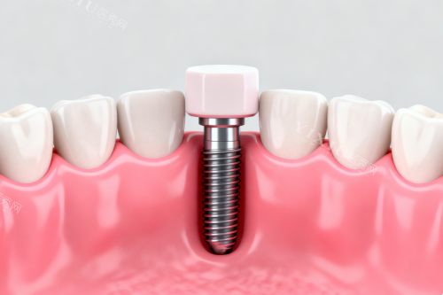 欧美进口种植牙一颗要多少钱？对比5大品牌价格，这样选比较划算！(图9)