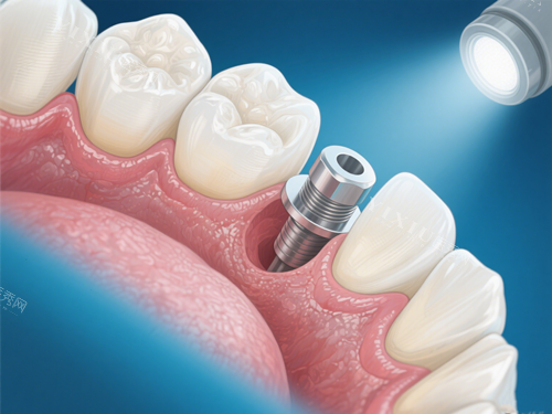 种植牙手术示意图