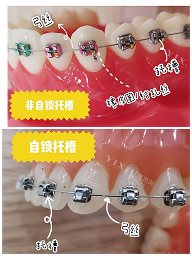 牙齿矫正自锁和非自锁牙套区别