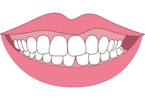 牙齿轻微畸形卡通图片展示