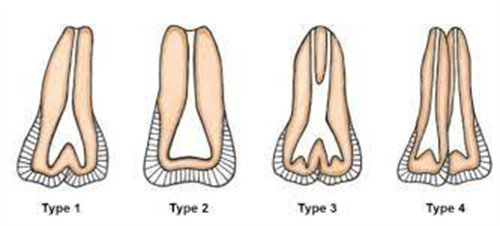正常牙齿和双生牙