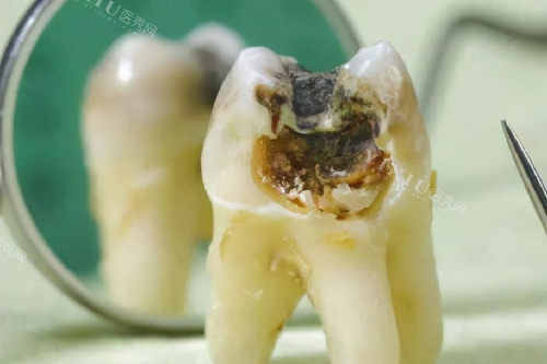 牙齿从根部开始烂图片