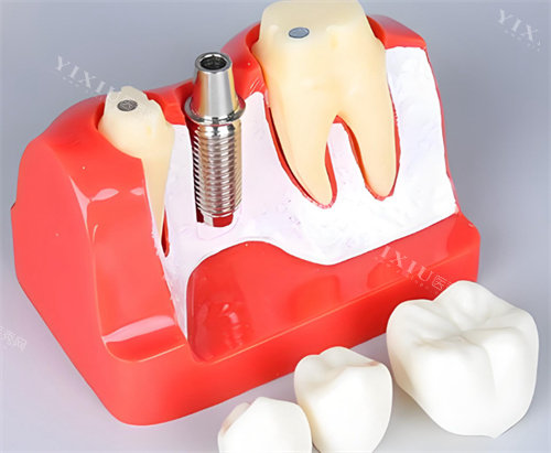 牙齿模型种植体