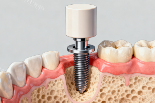大牙几乎没有了怎么办？牙医：先看牙根能不能留，再选3种修复方案(图6)