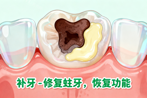 牙齿蛀牙修复展示图