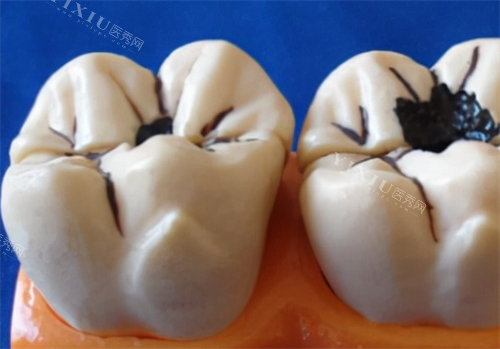 轻度和重度龋齿模型展示