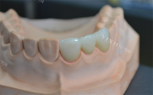 安装在牙齿模型上的全瓷牙成效