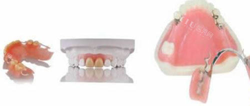 活动假牙佩戴过程示意图