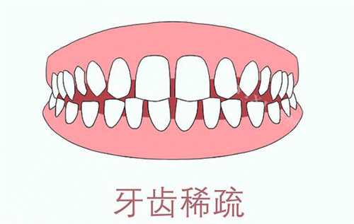 牙齿稀疏卡通示意图