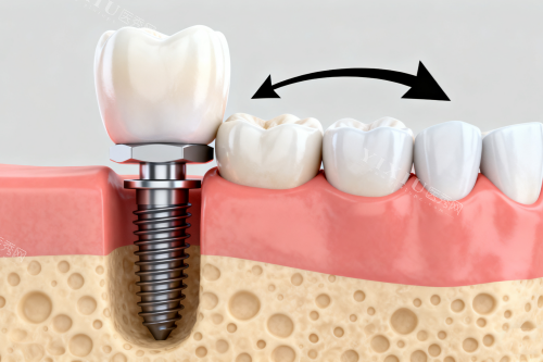 种植体与正常牙齿对比图