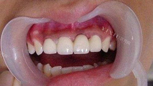 烤瓷牙后的牙齿情况