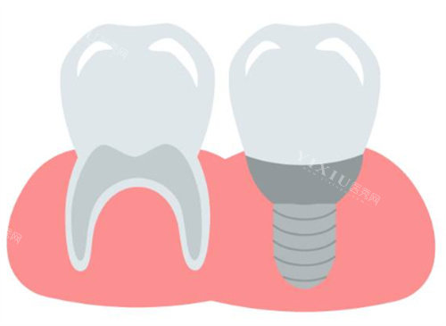 种植牙和牙齿图