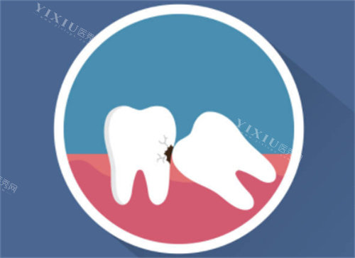 牙齿拥挤示意图