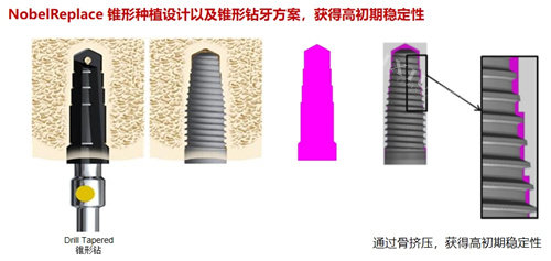 诺贝尔种植牙 (2)