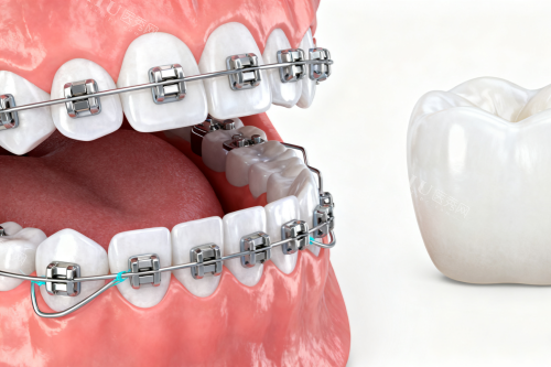 牙齿矫正卡通展示