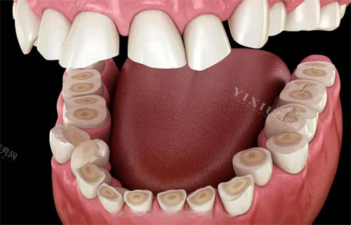 牙齿磨平展示图