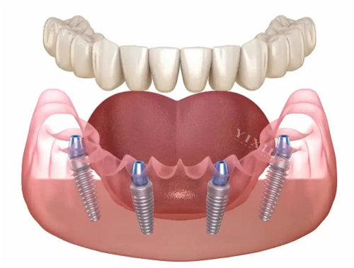 种植牙展示卡通图