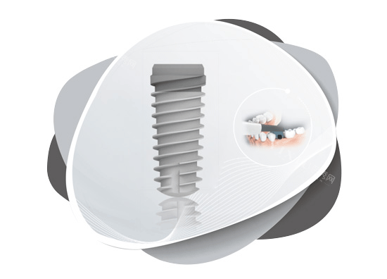大清西格种植牙照片图