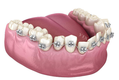 金属矫正牙齿动画示意图