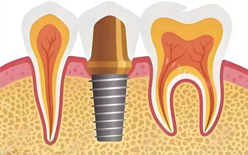种植牙展示图片展示图